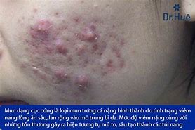 Cục Cứng Dưới Da Không Đau